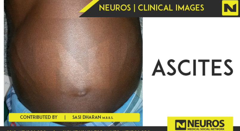 Ascites