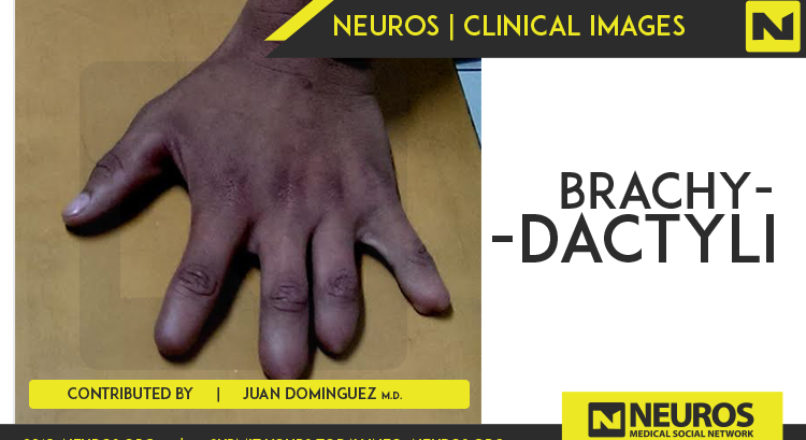 Brachydactyly