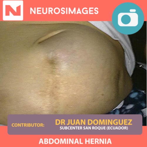 Abdominal Hernia