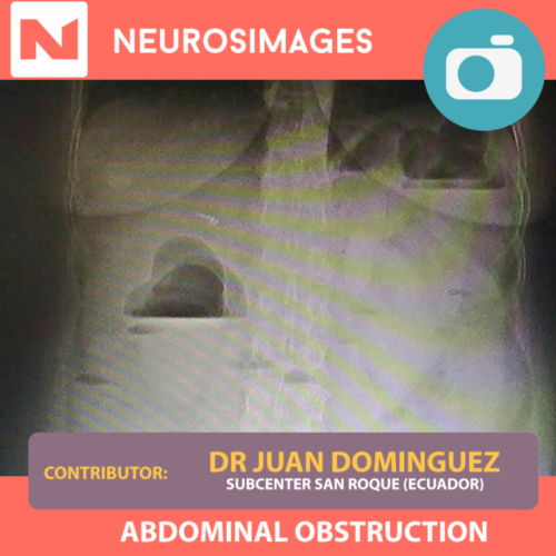 Abdominal Obstruction