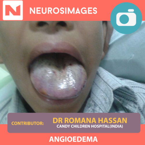 Angioedema