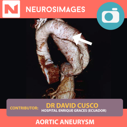 Aortic Aneurysm