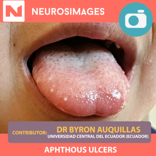 Aphthous Ulcers
